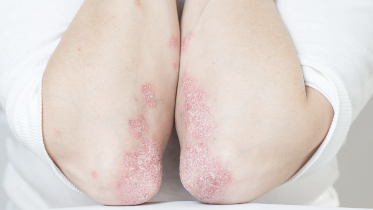 Psoriasis Management Near North Beach Maryland
